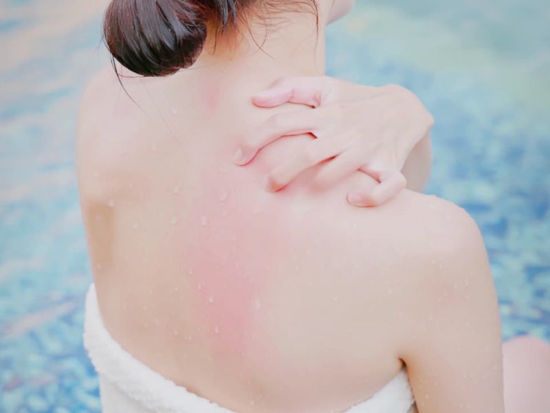 devojka obavijena u peškir sedi na pločicama na bazenu i češe svoja leđa, izražena iritacija na njenim leđima